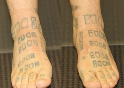 Amateur Feet Tattoos Before Laser Removal