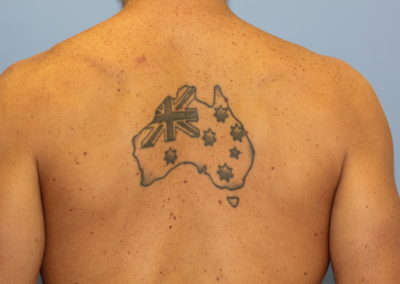 Black Back Tattoo Before Laser Tattoo Removal