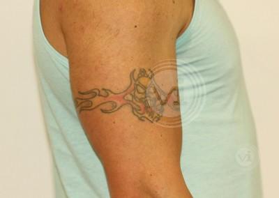 Coloured arm tattoo before treatment