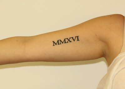 Black Inner Bicep Roman Numeral Tattoo Before Laser Tattoo Removal