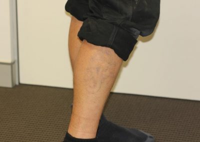 Black Leg Tattoo After 5 Laser Treatments