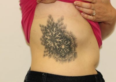 Black Rib Snowflake Tattoo Before Laser