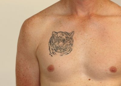 Black Tiger Chest Tattoo Before Laser