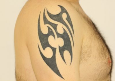 Black Tribal Shoulder Tattoo Before Laser Tattoo Removal