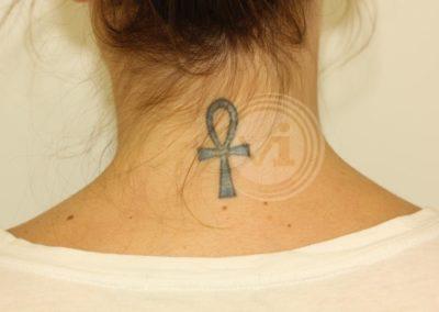 Blue neck tattoo before laser