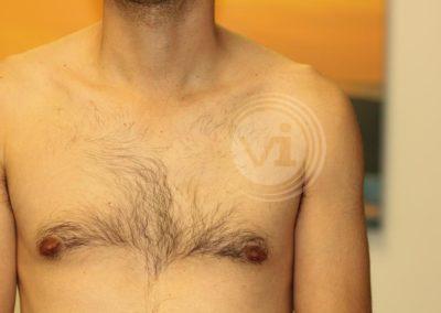 Black crucefix tattoo on chest after laser removal