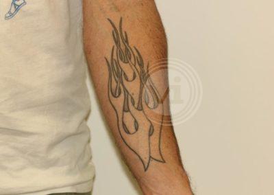 Black flame forearm tattoo before laser
