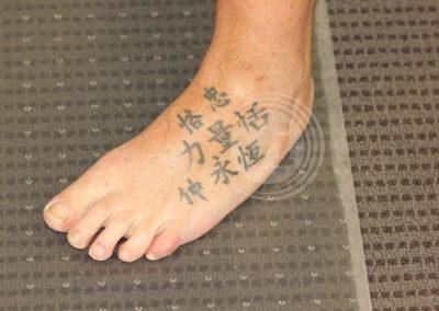 Black foot tattoo before laser
