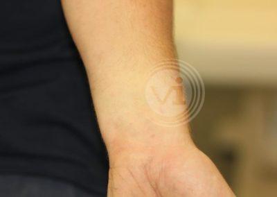 Black wrist tattoo after laser removal