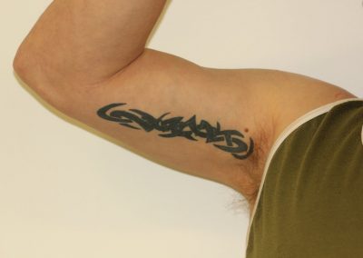 Black large inner bicep tattoo before laser tattoo removal