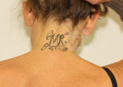 Black-neck-tattoo-before laser-removal