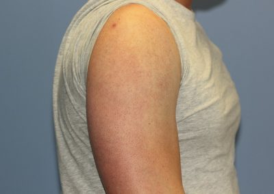 Black shoulder tattoo after laser tattoo removal
