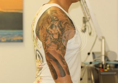 Large black sleeve tattoo 6 weeks after 1 treatment