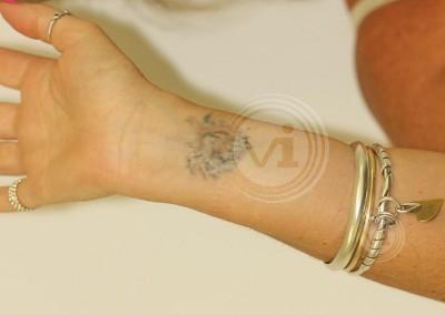 Wrist tattoo damaged by non laser removal