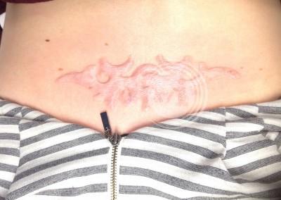 Lower back tattoo scar after treatment