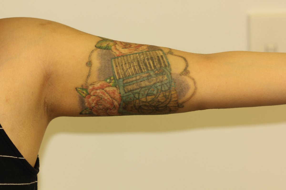 Coloured Cover Up Inner Bicep Tattoo After Laser