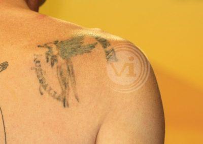 Coloured shoulder tattoo after laser fade