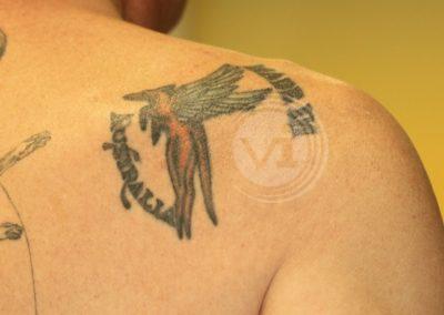 Black shoulder tattoo before laser fade