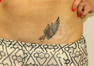 Dark Tummy Cover Up Tattoo Before