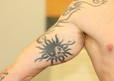 Dark inner bicep tattoo before laser