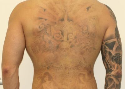 Full Back Tattoo After 3 Laser Treatments