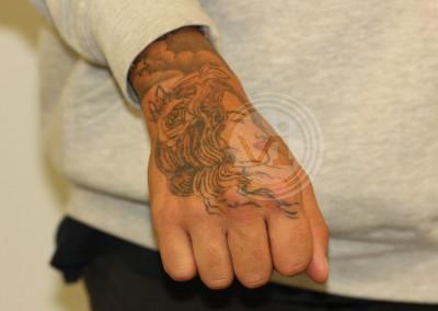 Hand tattoo before treatment