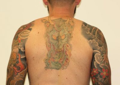 Coloured Back Tattoo Fade After Laser