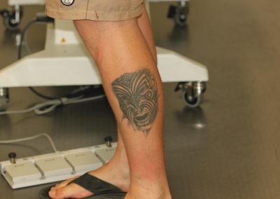 Large Black Leg Tattoo Before Laser