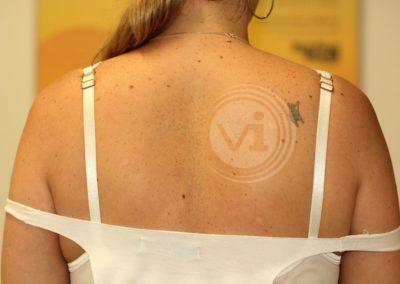Large black cross tattoo on back after laser
