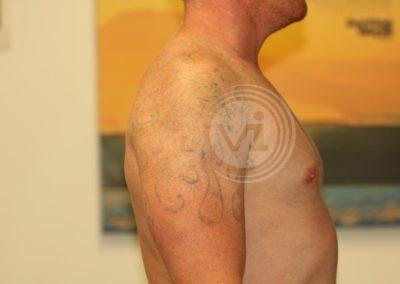 Large black shoulder tattoo after laser fade