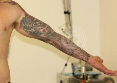 Large full inner sleeve tattoo before laser
