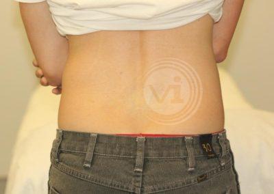 lower-back-tattoo after removal