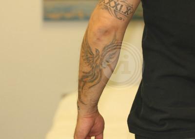 Very dark forearm tattoo after 5 treatments
