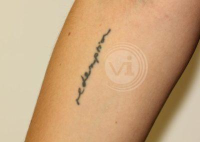 Black script tattoo on arm before laser