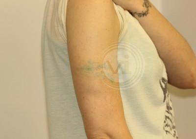 Coloured arm band tattoo after 4 treatments