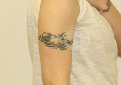 Coloured arm band tattoo before treatment