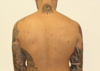 Black Back Tattoo Fade after 6 Laser Treatments