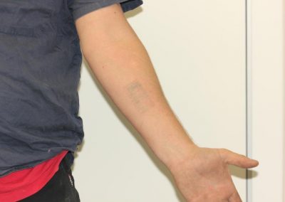 Black Barcode Tattoo on Forearm After 5 Laser Treatments