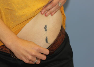 Black Belly Tattoo Before
