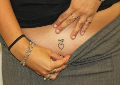 Black Hip Initial Tattoo Before Laser Tattoo Removal