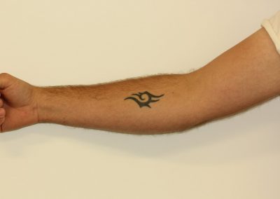 Black Inner Forearm Tattoo Before Laser Tattoo Removal