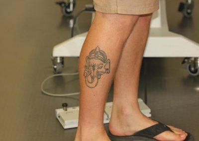 Black Leg Tattoo Before Laser