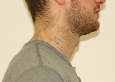 Black Neck Tattoo Residual Before Cropped
