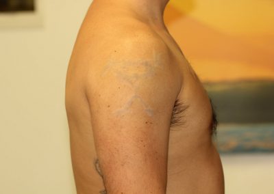 Black Pearl Jam tattoo after laser tattoo removal