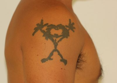 Black Pearl Jam tattoo before laser tattoo removal