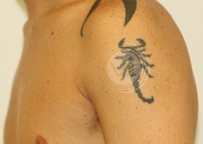 Black Shoulder Scorpion Tattoo Before