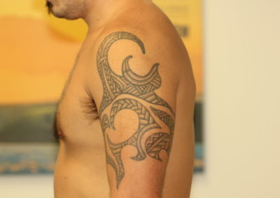 Black Tribal Tattoo Before Laser Tattoo Removal