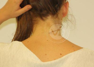 Blue neck tattoo after laser removal