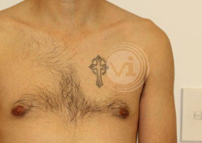 Black crucefix tattoo on chest before laser