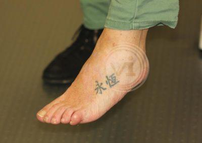 Black foot tattoo after laser removal